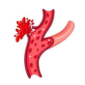 Arterielle Blutungen